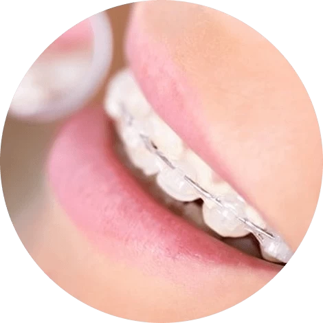 Баннер Брекеты в Казани – металлические и керамические от известных производителей